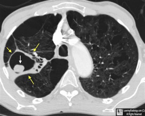 Learningradiology Aspergilloma Aspergillosis Fungus Ball