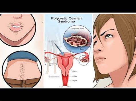 تخمدان پلی کیستیک PCOS یا تنبلی تخمدان و عوارض آن بر روی پوست و مو