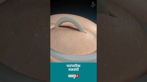 पारंपारिक नसबंदी शस्त्रक्रिया ↪ 3d Medical Animation Shorts Vasectomy