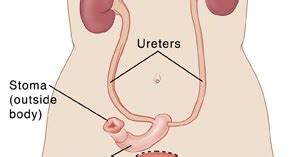 Ileal Conduit Pictures, Indications, Complications, Procedure, Care ...