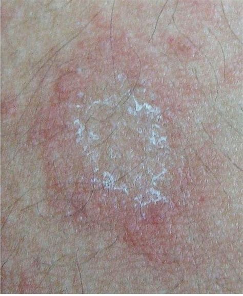 Pityriasis Rosea Gianotti Crosti Syndrome Asymmetric Periflexural