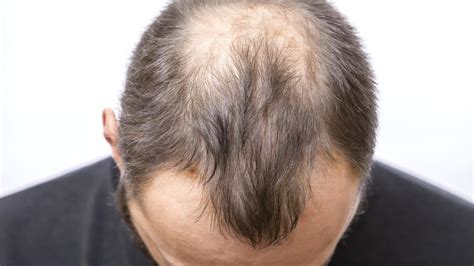 Perte De Cheveux Et Calvitie Quelles Sont Les Causes De L Alop Cie