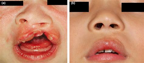 Straight Line Repair Of Unilateral Cleft Lip New Operative Method