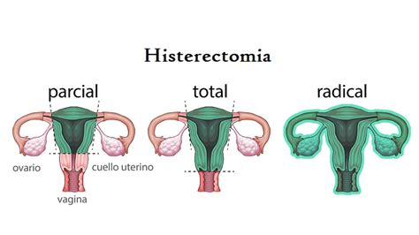 ¿qué Es La Histerectomía Y ¿cuáles Son Sus Indicaciones