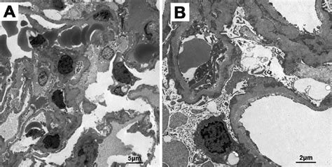 Figure2 Electron Microscopy Image Showing Granular Electron Dense