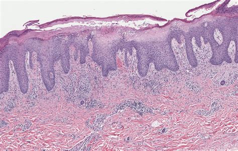 Global Skin Path Atlas | Diagnosis Detail