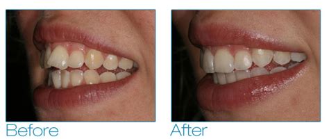 Getting Your Teeth Straightened In 6 Months Masri Orthodontics