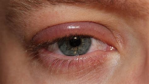 What is Blepharitis? | Symptoms and Treatment