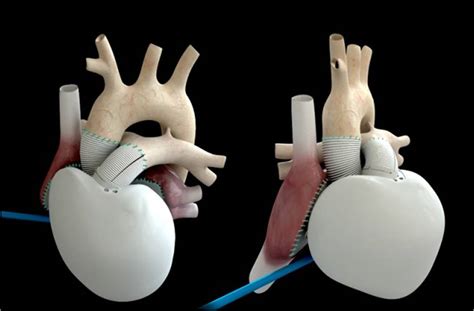 Cœur artificiel total caractéristiques et premiers résultats du