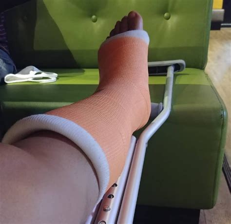 Broken Ankle Leg Cast SLC After Surgery STORIES INJURED