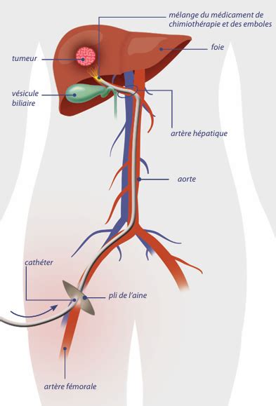 Le Traitement Du Carcinome Hépatocellulaire Fondation Arcad