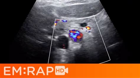 Aortic Dissection Ultrasound