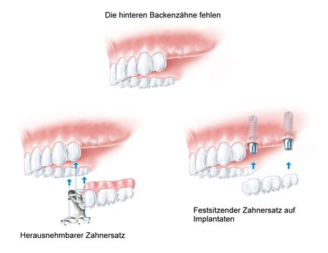 Zahnimplantate: Zahnarzt Köln, Maarweg