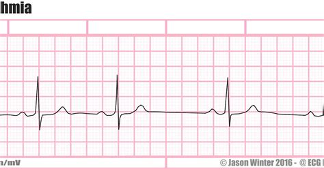 ECG Educator Blog : Sinus Arrhythmia