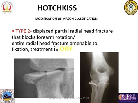 Radial Head Fracture Ppt