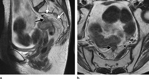 Relationship Of Tumor To The Pelvic Sidewall Sagittal A And