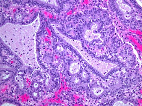 Epithelioid hemangioendothelioma – Blog | PathologyOutlines.com