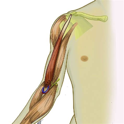 Intraoperative View Of The Antecubital Fossa Dissection Download