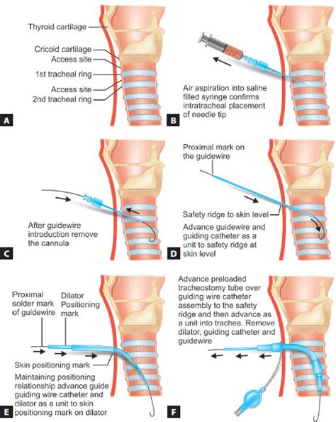 Tracheostomy Procedure Steps