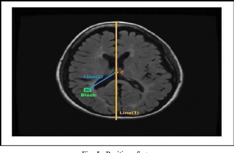 Figure 1 From Automatic Segmentation Of Multiple Sclerosis Lesions In Brain Mr Images Using