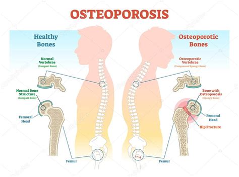 osteoporosis system disorder template