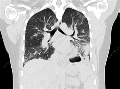 Lungs With Vaping Damage Ct Scan Stock Image C Science