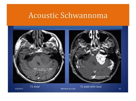 Intracranial Space Occupying Lesions Ppt