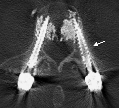 Patient Specific Template Guided Versus Standard Freehand Lumbar