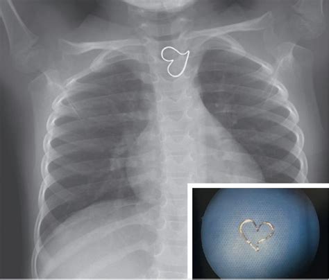 Here's Why a Perfect Heart Shape Showed Up on a Girl's X-Ray | Live Science