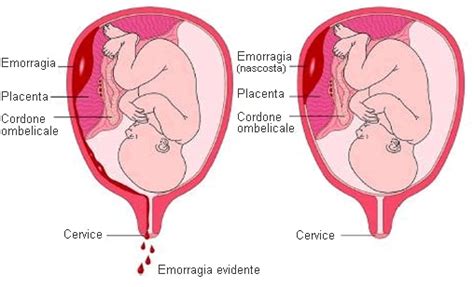 Distacco Di Placenta