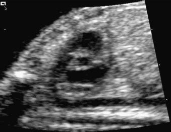 Fetal Heart Views Normal Ultrasound