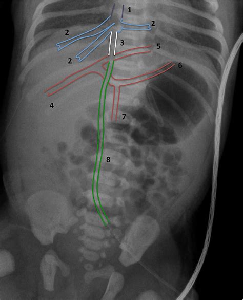 Figure 1 From Umbilical Venous Catheters Placement Evaluation On