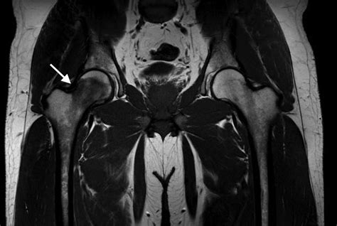 Normal Hip Mri