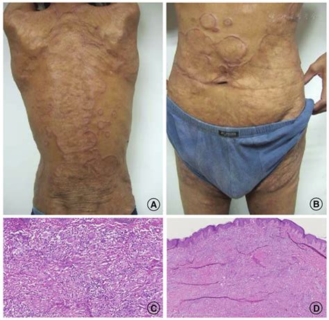 Annulare With Tuberculosis And Cutis Laxa A Rare Case Report