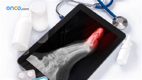 Recurrent treatment And Survival Rates For Bone Cancer | Onco.com