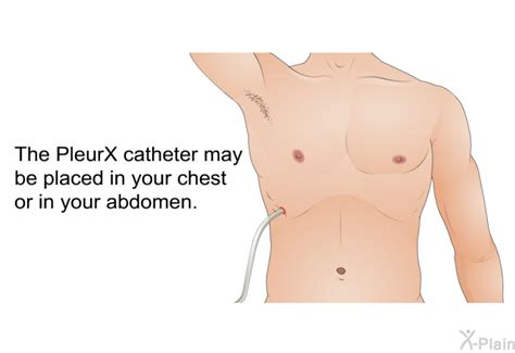 Pleurx Catheter