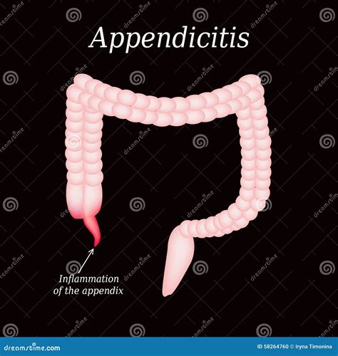 Appendicitis Inflammation Of The Appendix Colon Stock Vector