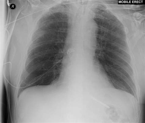 Mucus In Lungs X Ray