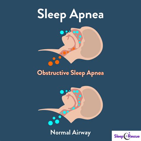 What Is Sleep Apnea Learn In Omaha Sleep Rescue