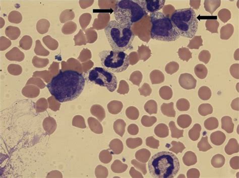 Figure 1 From Leukemoid Reaction To Clostridium Difficile Infection