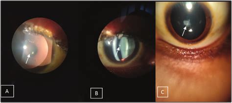 Anterior Segment Slit Lamp Findings A Right Anterior Oil Droplet