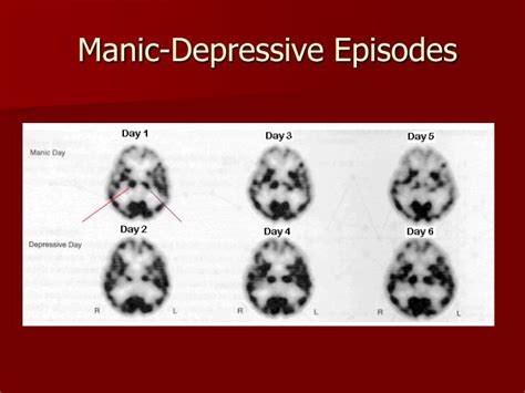 Ppt Depression Schizophrenia And Bipolar Disorder Powerpoint