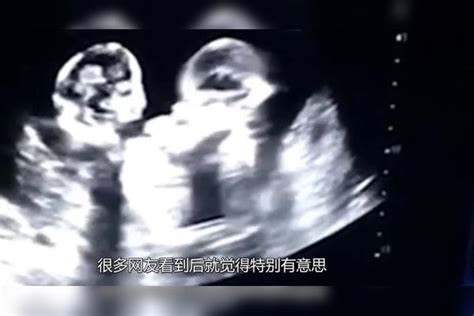 最奇葩双胞胎，在妈妈肚子里“打架”，医生：这不是一般双胞胎双胞胎肚子妈妈