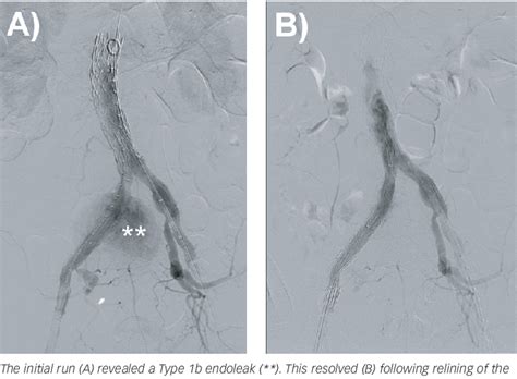 Figure 2 From An Ilio Iliac Arteriovenous Fistula Following Spontaneous