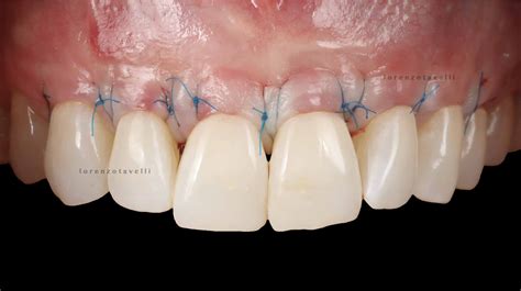 Soft Tissue Management around Natural Teeth - MIAMI Institute