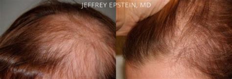 Hair Transplants For Women Special Cases Photos Miami Fl Patient42053