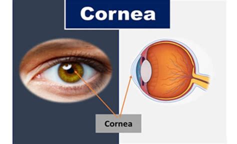 Corneal Transplant Corneal Transplant Cost Dr Anisha Gupta