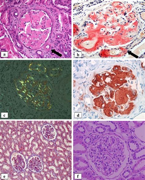 A Photomicrograph Shows One Glomerulus There Is Mesangial Expansion