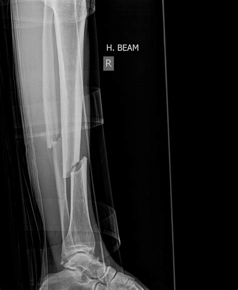 Bone Fracture Healing