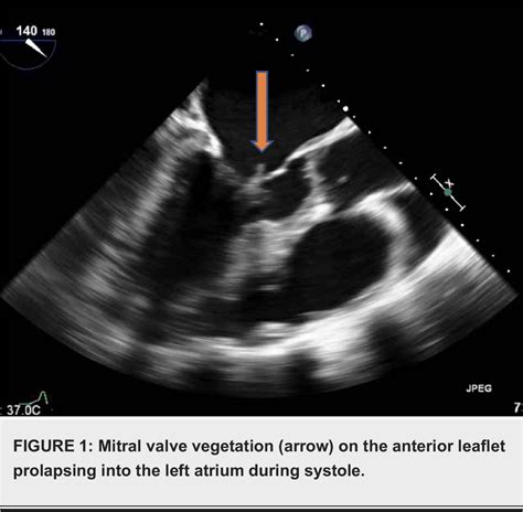 Figure 1 From Streptococcus Viridans Endocarditis Affecting All Four Valves Semantic Scholar